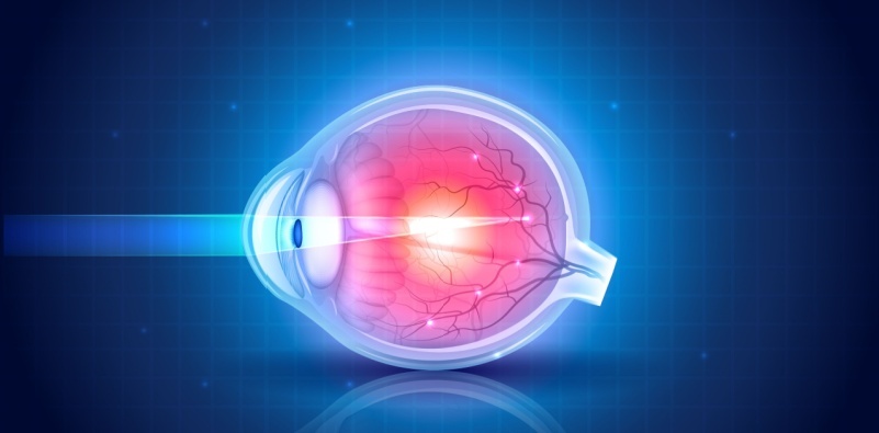 A detailed illustration of an eye affected by myopia