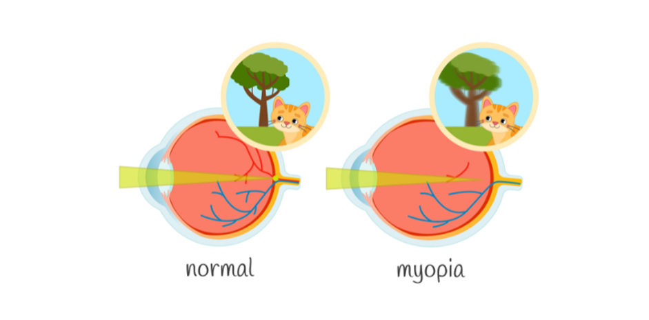 An illustration of a normal eye and vision alongside an eye with myopia